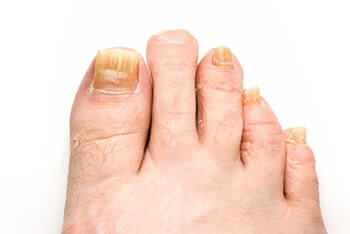 toenail fungus treatment, Fungal nail treatment in the San Diego & San Bernadino County, Central CA Coast, including Santa Maria, as well as Vista CA 92081