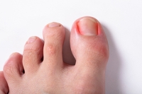Ingrown Toenails in Children